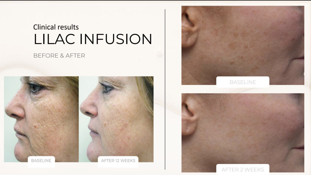 Lilac Infusion – product details, medical-grade skincare by Zahav Medspa